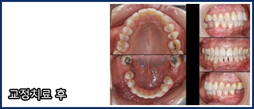 잇몸질환 등으로 틀어진 치아들의 교정
